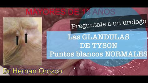 que son las glandulas tyson|Pápulas perladas